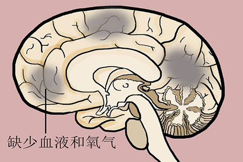 经颅磁刺激仪治疗一次费用|脑梗塞的前兆有哪些 